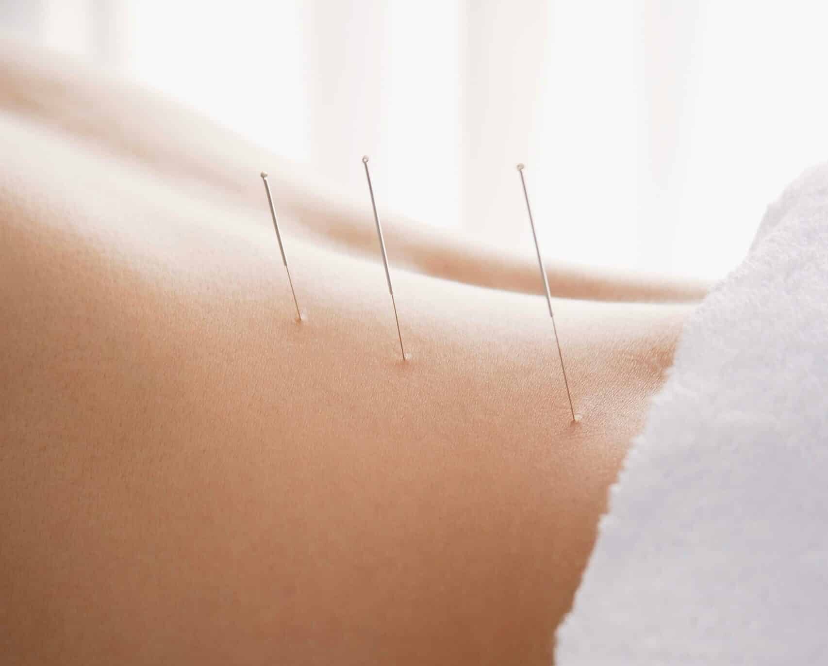 Acupuncture